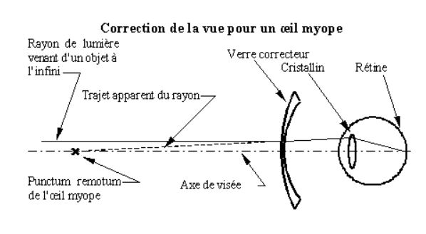 Je suis myope Magnitude 78